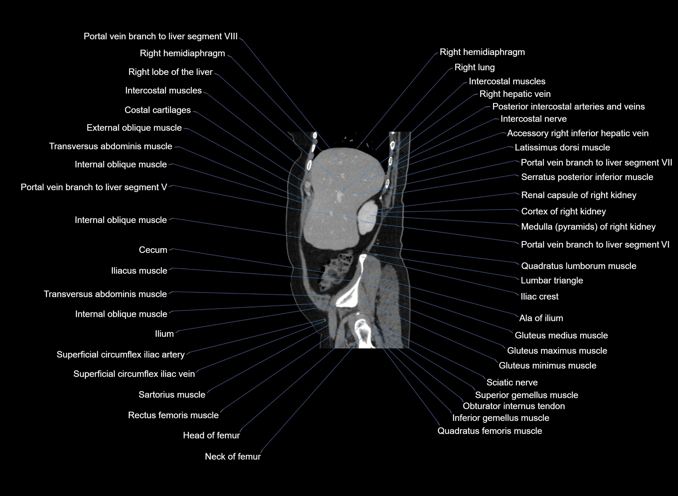 CT Abdomen sagittal cross sectional anatomy labelled radiology image -00090.webp